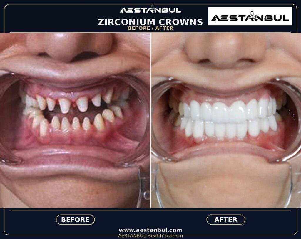 Dental Crowns Aftercare Timeline - Dental Crowns Aftercare Timeline: Aftercare Timeline Questions for 2026