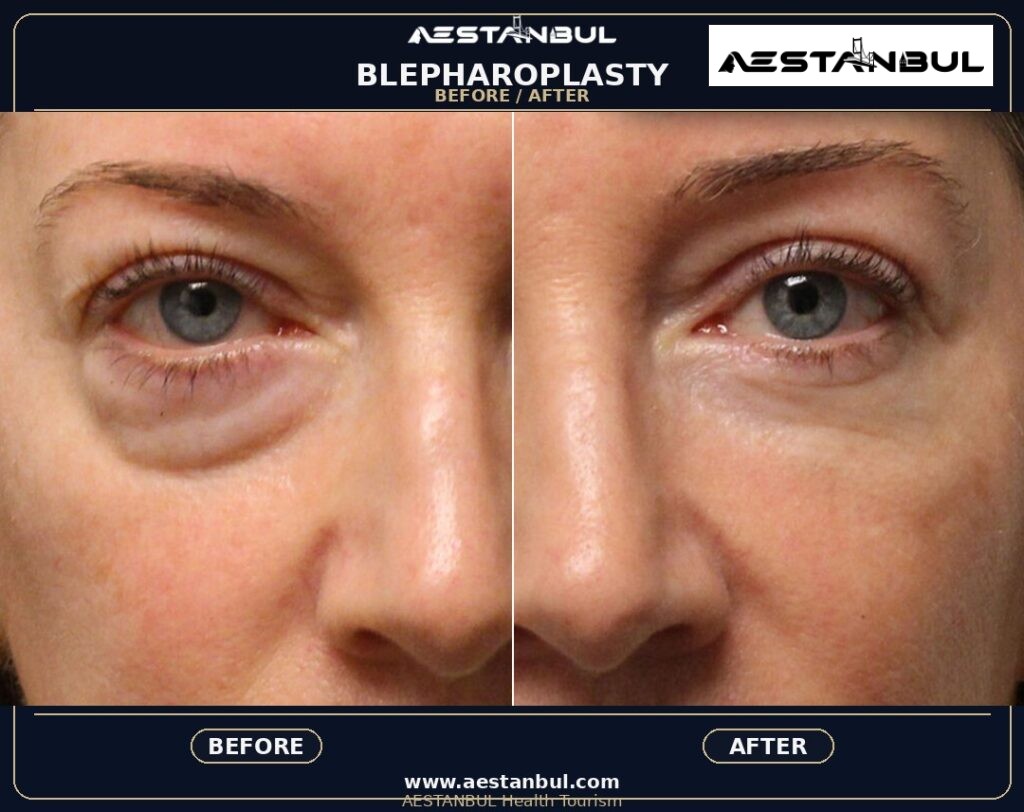 Blepharoplasty Photo Consultation - Blepharoplasty Photo Consultation: Photo Consultation Checklist for 2026