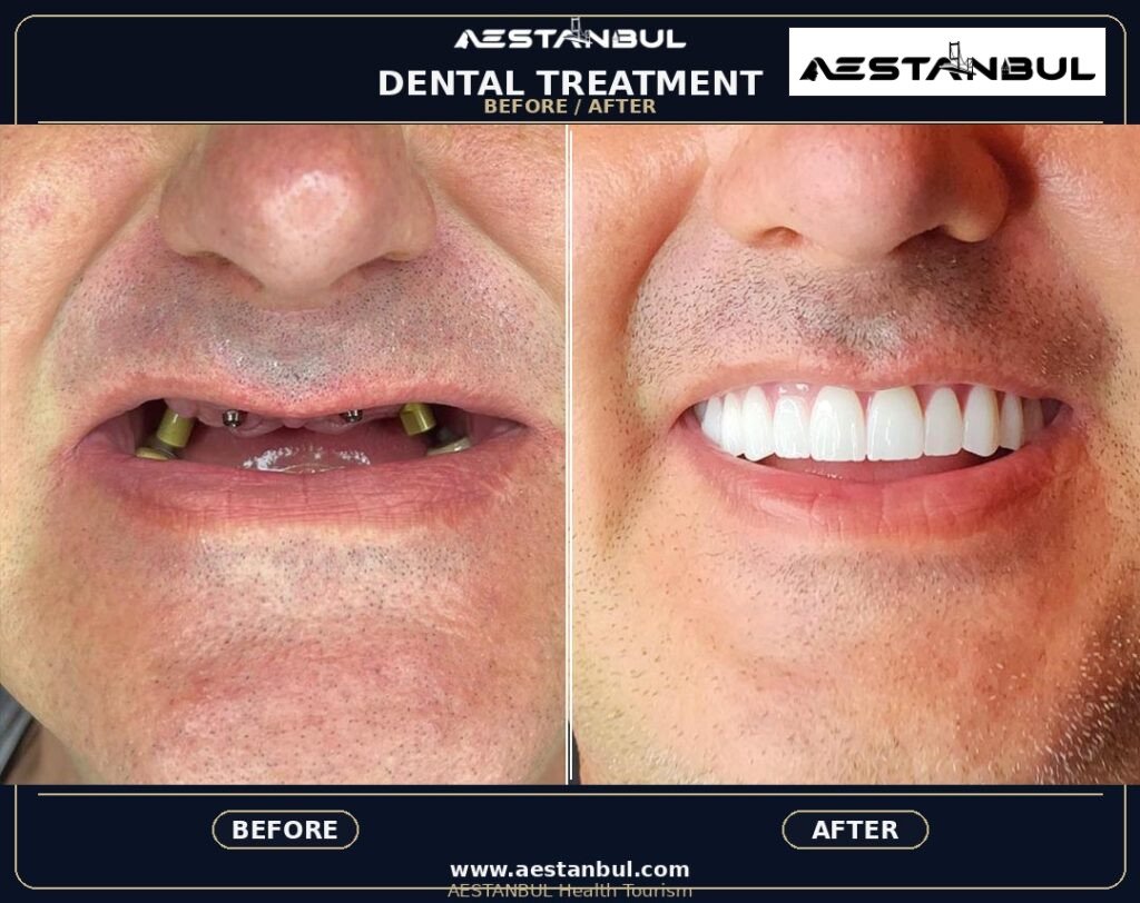 Smile Makeover - Smile Makeover: Patient Guide in Turkey