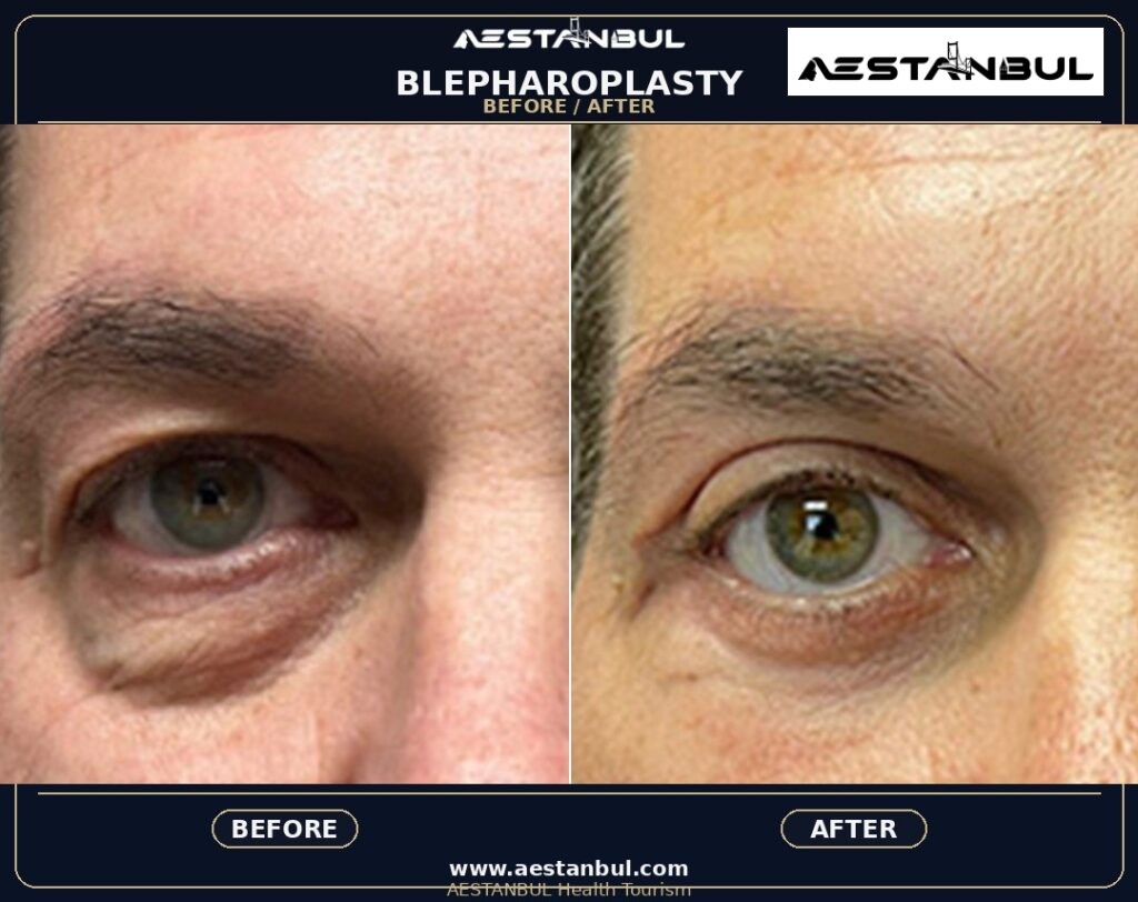 Blepharoplasty Photo Consultation - Blepharoplasty Photo Consultation: Photo Consultation Checklist for 2026