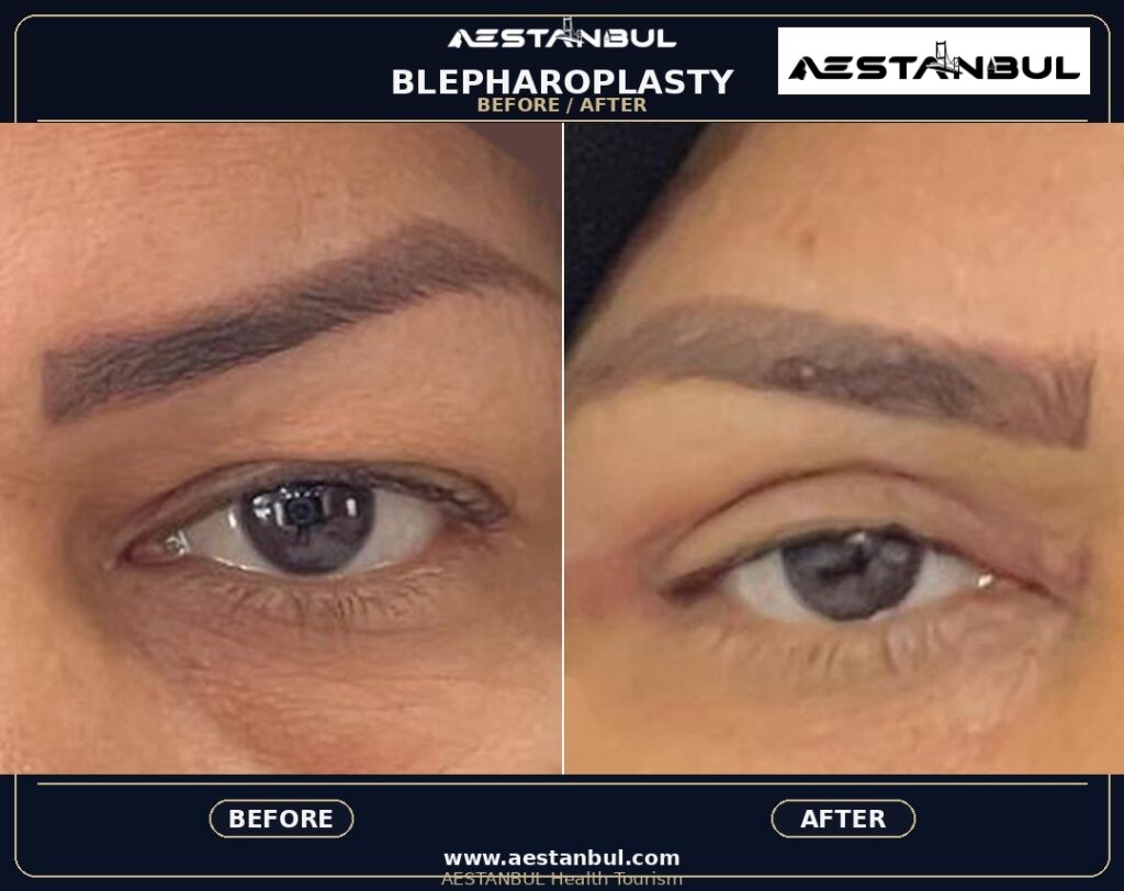 Blepharoplasty Photo Consultation - Blepharoplasty Photo Consultation: Photo Consultation Checklist for 2026