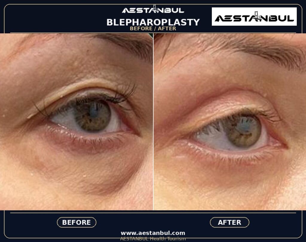 Blepharoplasty Photo Consultation - Blepharoplasty Photo Consultation: Photo Consultation Checklist for 2026