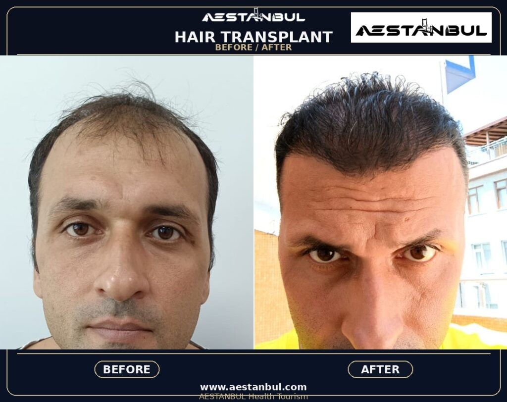 laser hair removal Istanbul - Laser Hair Removal Istanbul: What International Patients Should Know