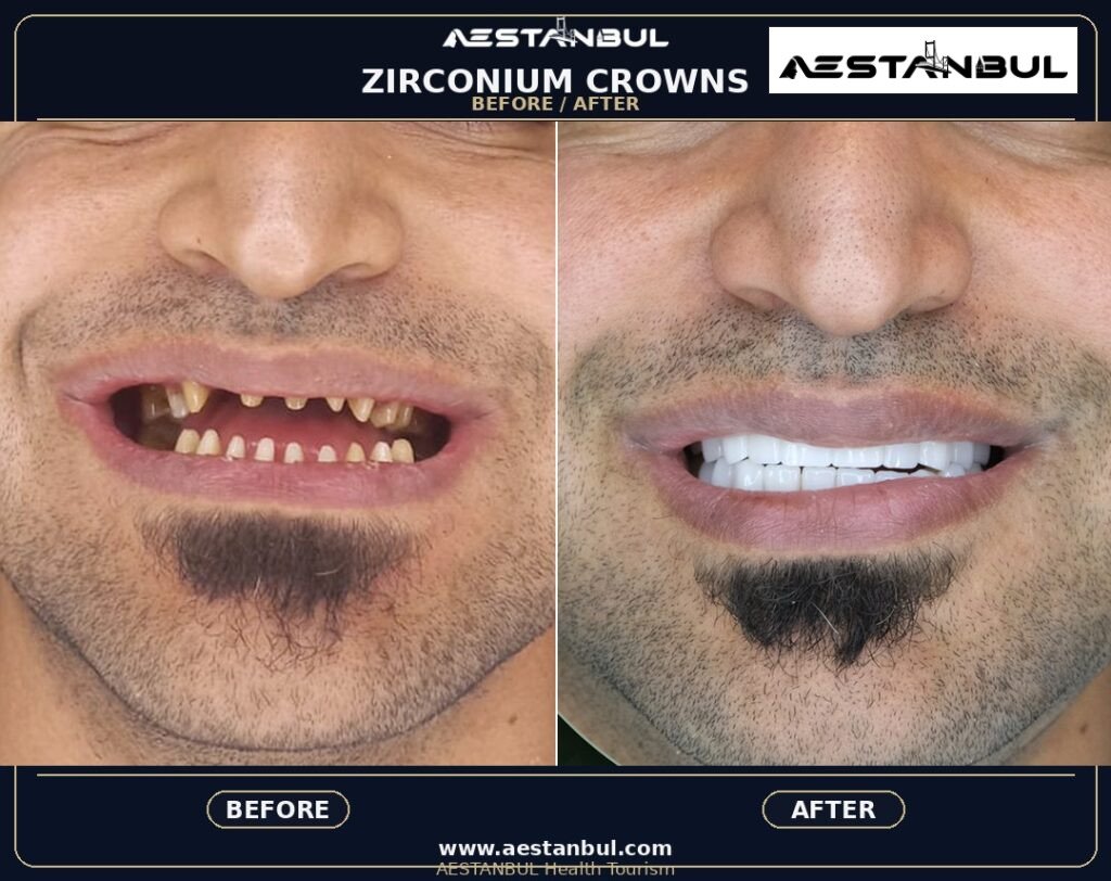 Dental Crowns Travel Guide - Dental Crowns Travel Guide: First-Time Medical Travel Guide for 2026
