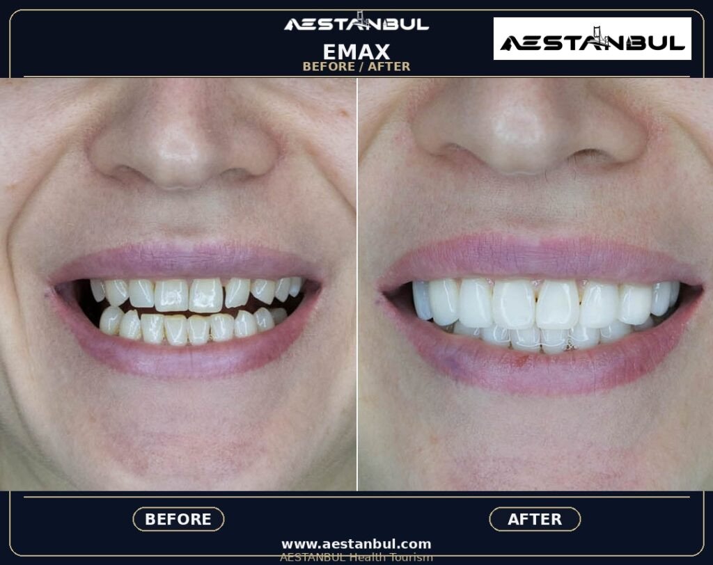 Dental Veneers Europe Package - Dental Veneers Europe Package: Package Review for European Patients for 2026