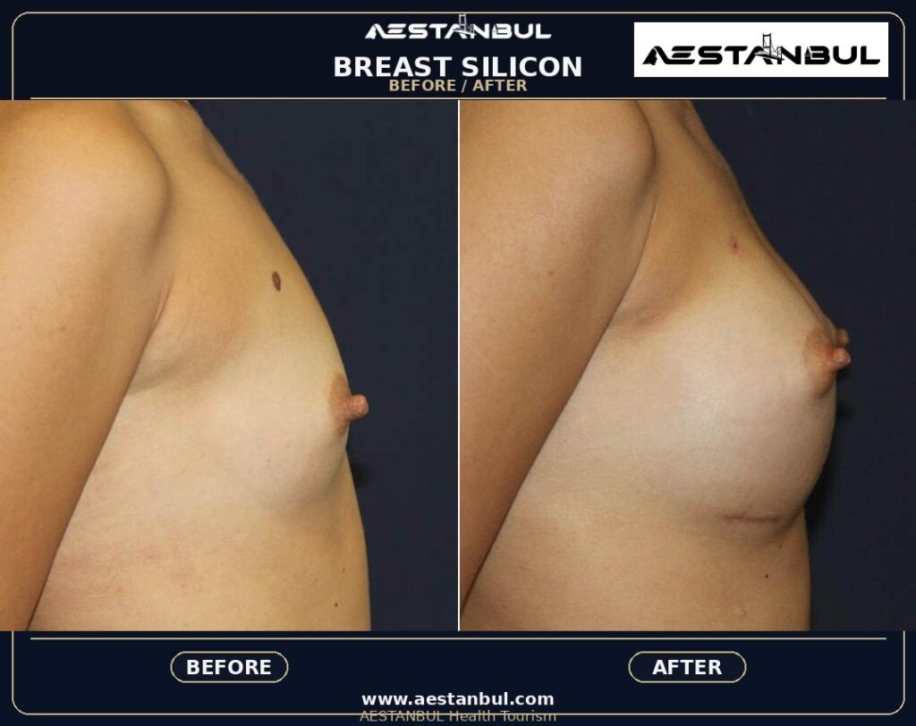 breast augmentation Turkey - Breast Augmentation Turkey: Patient Guide in Turkey