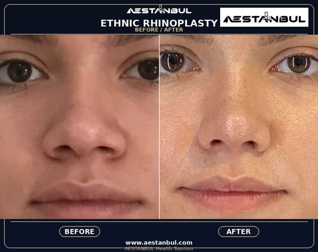 Revision Rhinoplasty Revision Questions - Revision Rhinoplasty Revision Questions: Revision Risk Questions for 2026