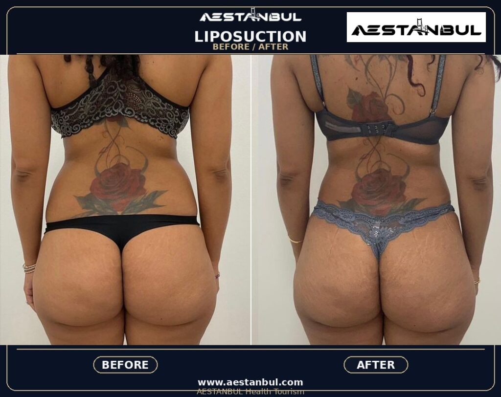 Liposuction Before And After Turkey: Results, Safety and Patient Questions 3 57d8263b