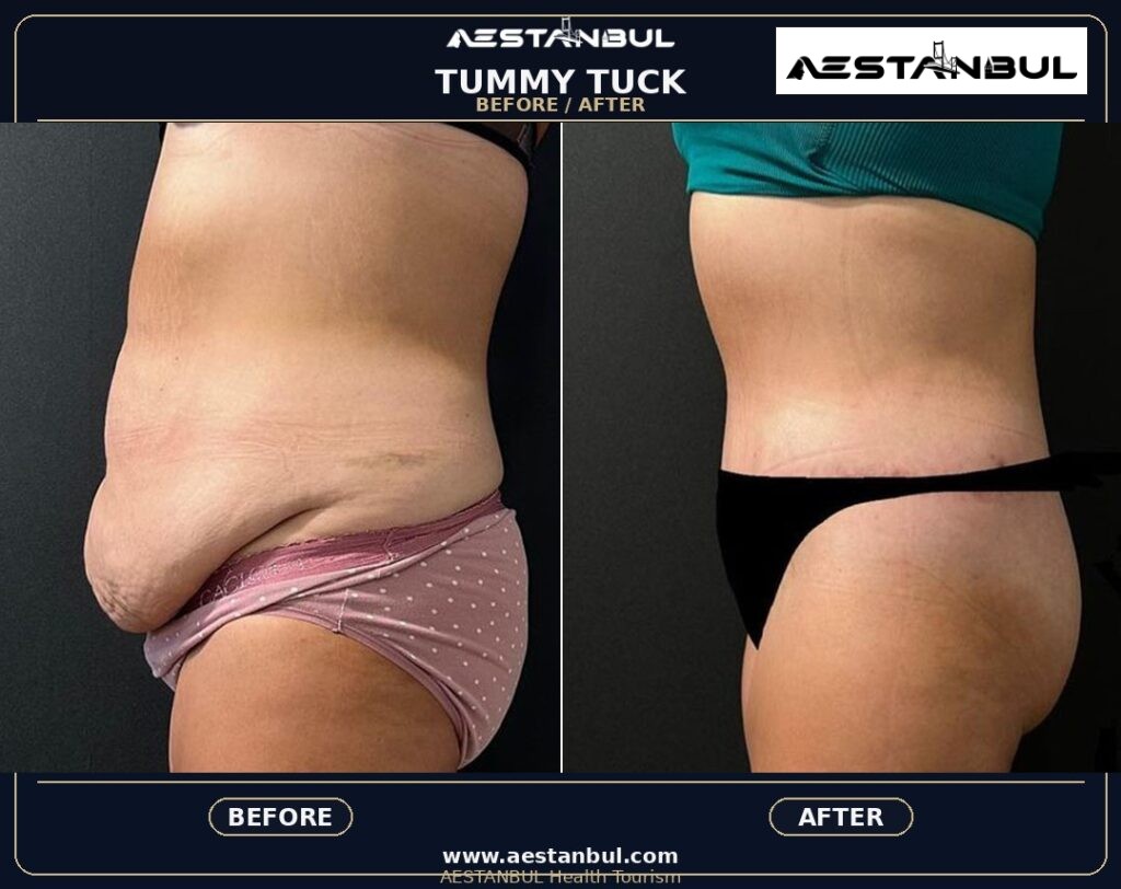 tummy tuck before and after Turkey - Tummy Tuck Before And After Turkey: Results, Safety and Patient Questions