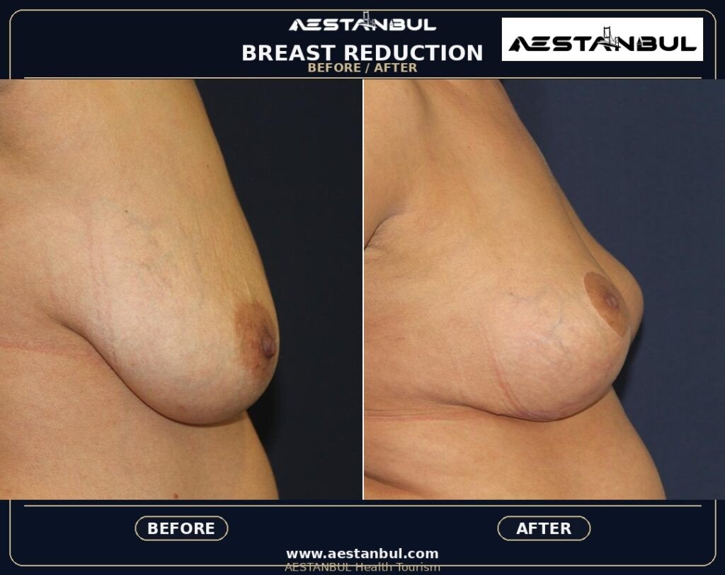 breast reduction Turkey - Breast Reduction Turkey: Patient Guide in Turkey