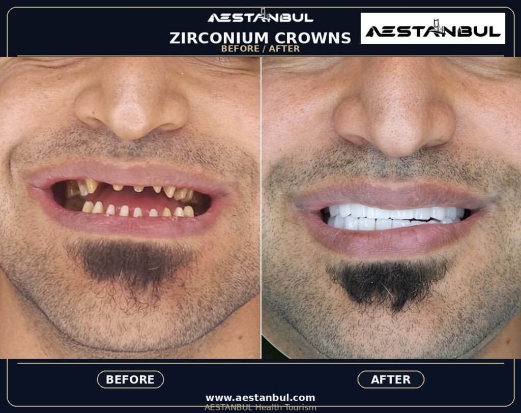 Dental Crowns Aftercare Timeline - Dental Crowns Aftercare Timeline: Aftercare Timeline Questions for 2026