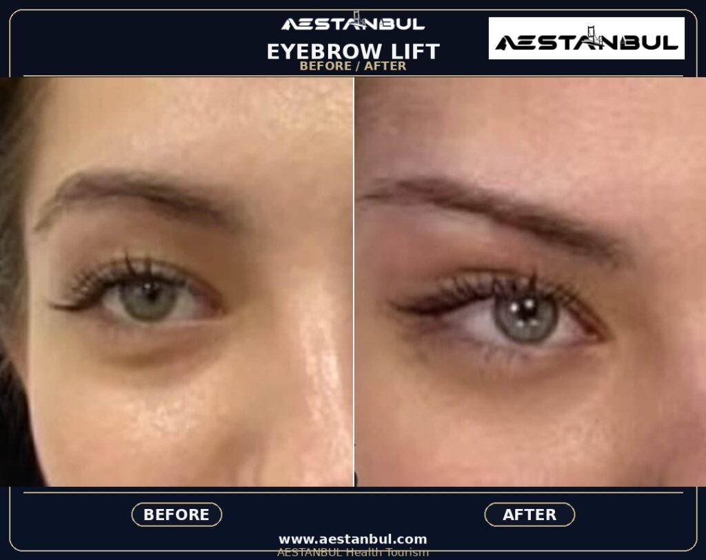 eyebrow transplant Istanbul - Eyebrow Transplant Istanbul: What International Patients Should Know