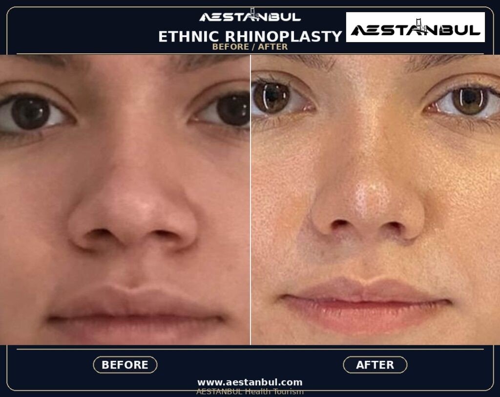 ethnic rhinoplasty Turkey - Ethnic Rhinoplasty Turkey: Patient Guide in Turkey