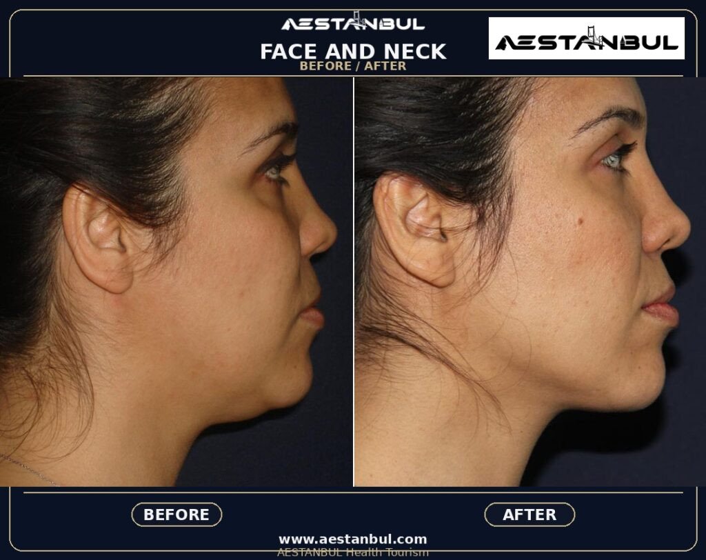 Facelift UK Checklist - Facelift Uk Checklist: UK Patient Checklist for 2026