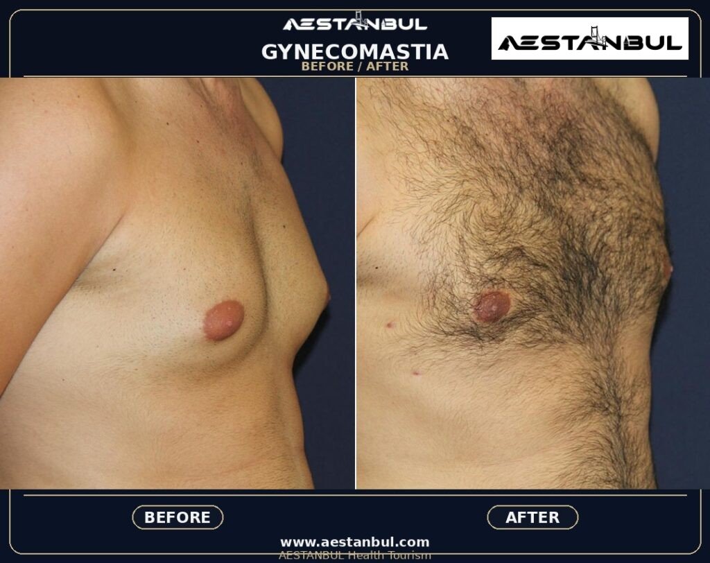 gynecomastia Turkey - Gynecomastia Turkey: Patient Guide in Turkey