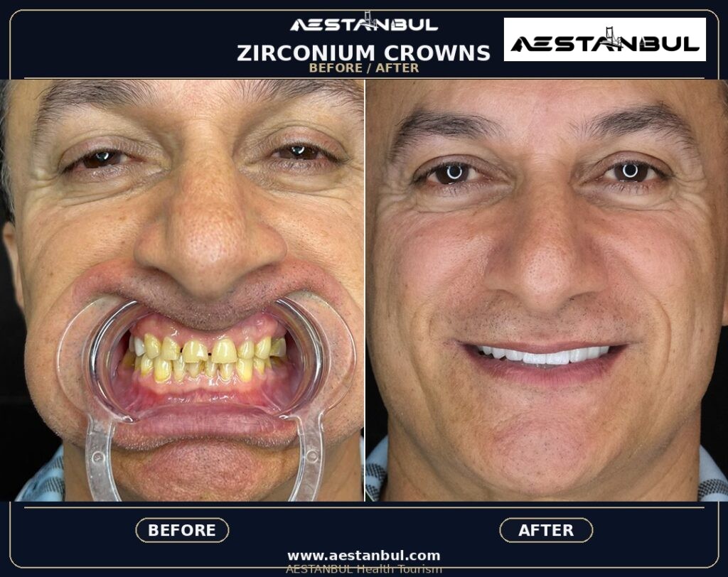 Corrective Jaw Surgery - Corrective Jaw Surgery: What International Patients Should Know