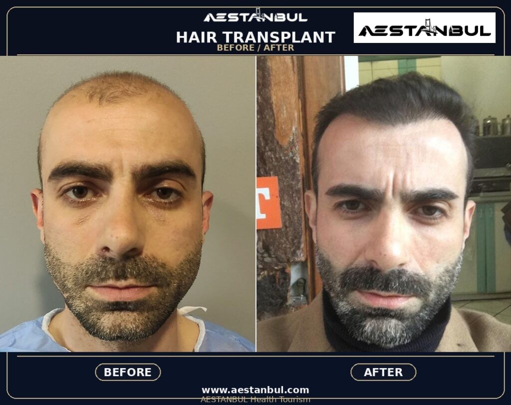 hair transplant before and after Turkey - Hair Transplant Before And After Turkey: Results, Safety and Patient Questions