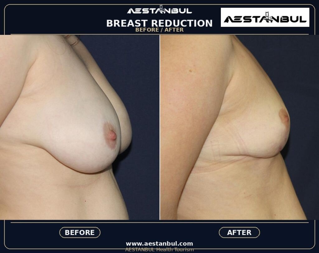 breast reduction Turkey - Breast Reduction Turkey: Patient Guide in Turkey