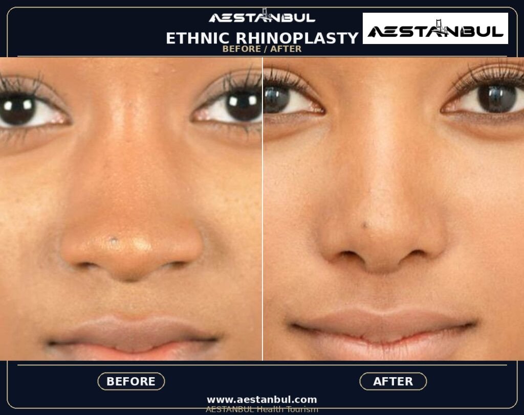 Rhinoplasty UK Checklist - Rhinoplasty Uk Checklist: UK Patient Checklist for 2026