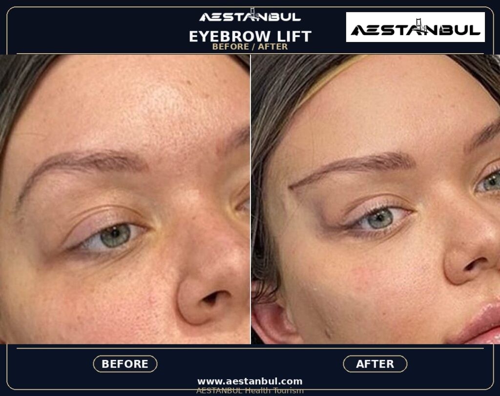 eyebrow transplant Istanbul - Eyebrow Transplant Istanbul: What International Patients Should Know