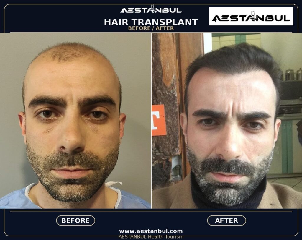 FUE Hair Transplant Photo Consultation - FUE Hair Transplant Photo Consultation: Photo Consultation Checklist for 2026