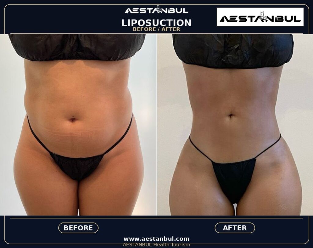 non surgical liposuction - Non Surgical Liposuction: What International Patients Should Know
