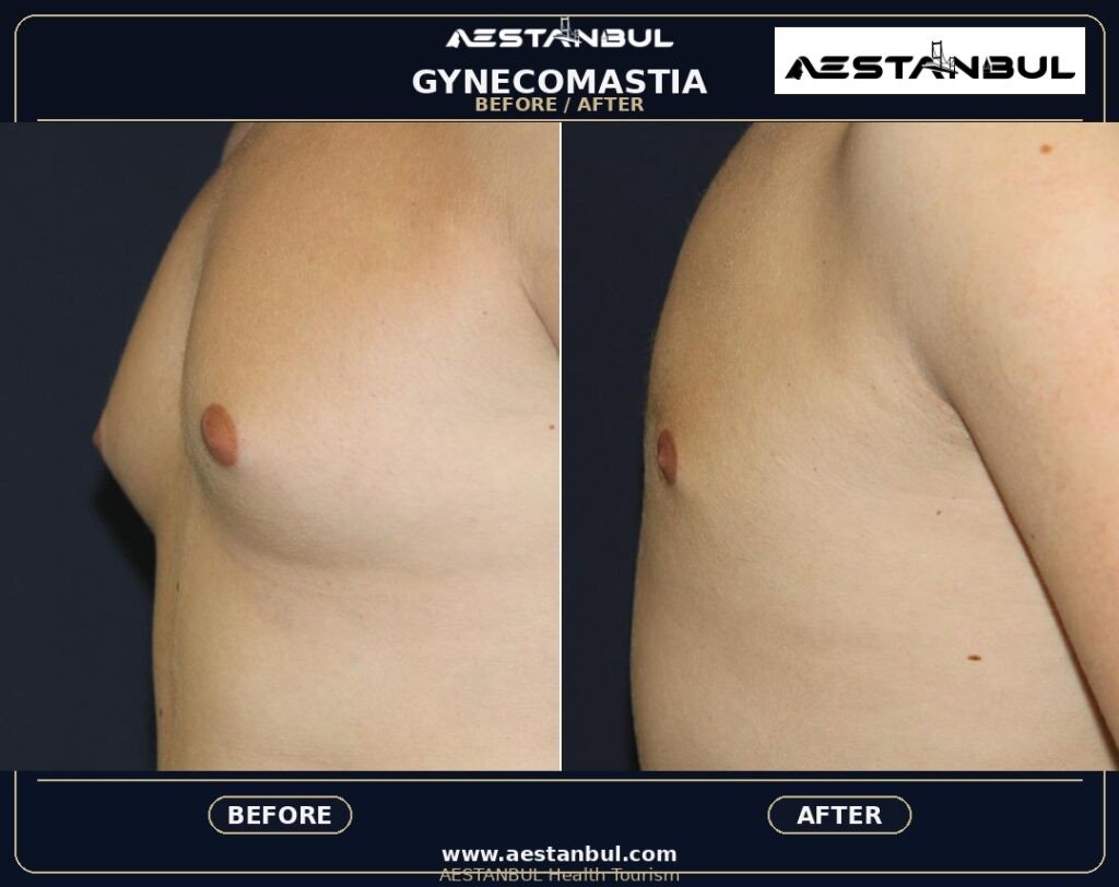gynecomastia Turkey - Gynecomastia Turkey: Patient Guide in Turkey