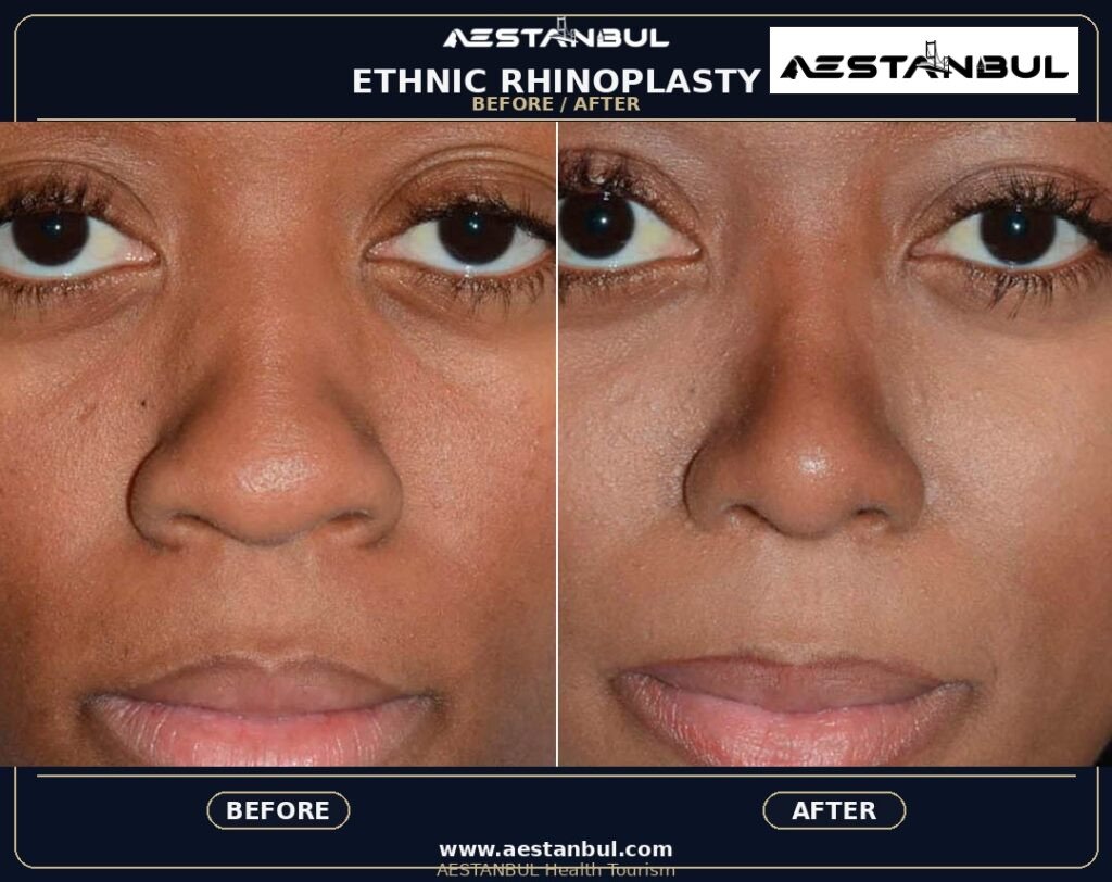 Revision Rhinoplasty Revision Questions - Revision Rhinoplasty Revision Questions: Revision Risk Questions for 2026