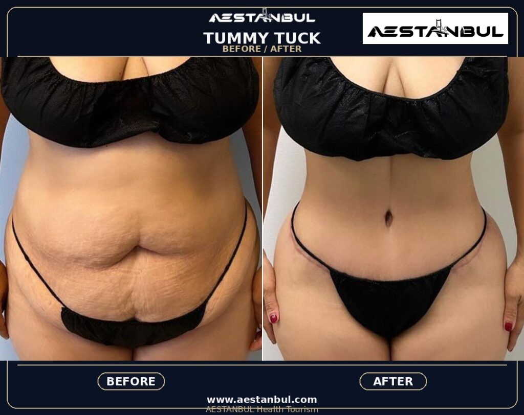 Tummy Tuck Deposit Questions - Tummy Tuck Deposit Questions: Deposit Questions Before Booking for 2026