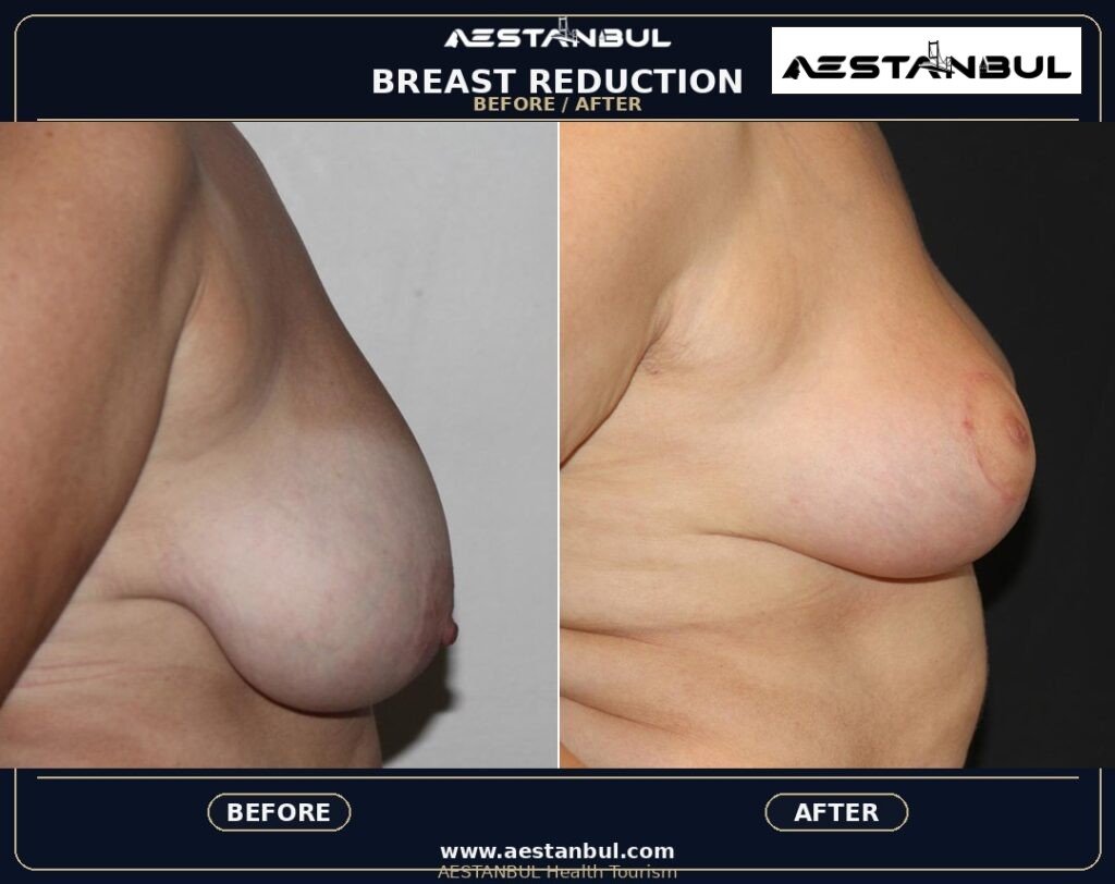 breast reduction Turkey - Breast Reduction Turkey: Patient Guide in Turkey