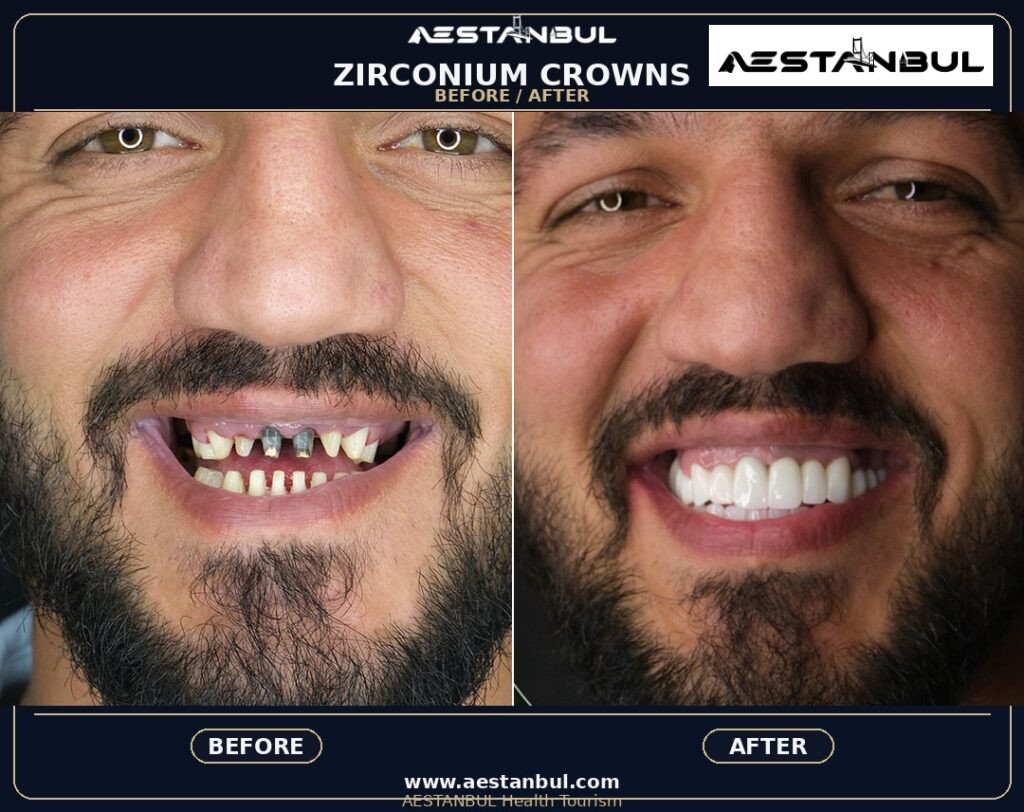 Dental Crowns Travel Guide - Dental Crowns Travel Guide: First-Time Medical Travel Guide for 2026
