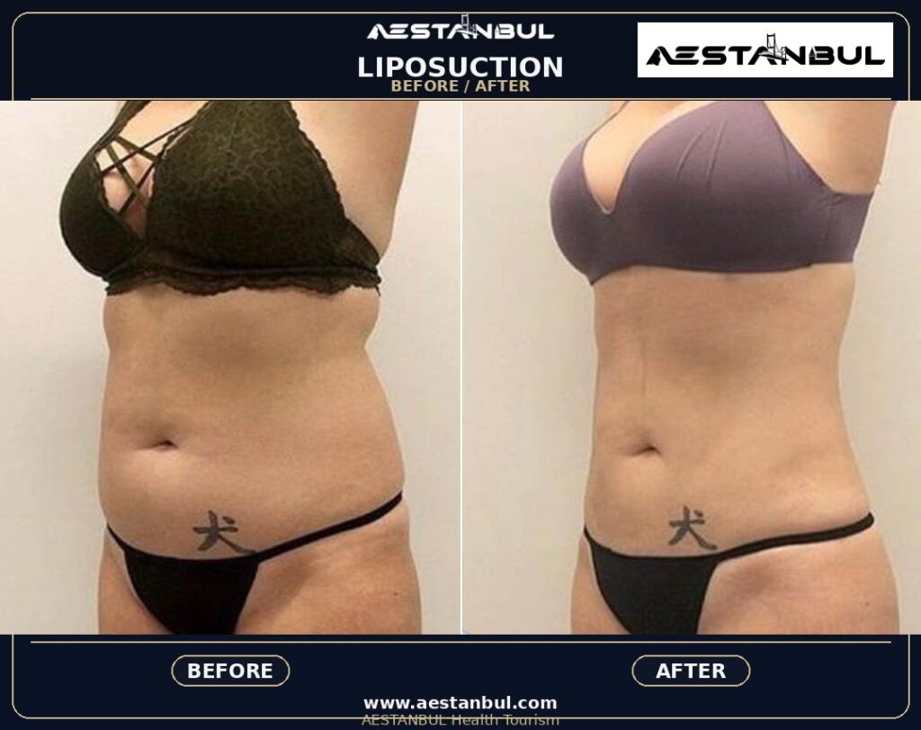 Liposuction Europe Package - Liposuction Europe Package: Package Review for European Patients for 2026