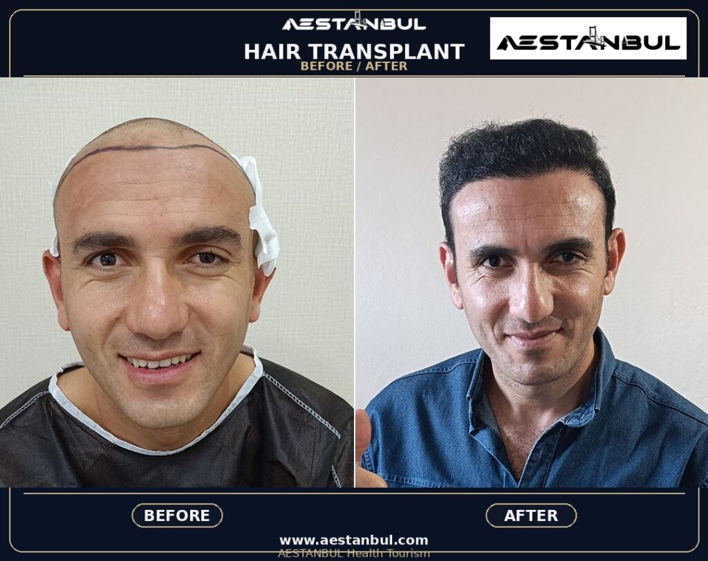Hair Transplant Before And After Turkey: Results, Safety and Patient Questions 5 B440a7db