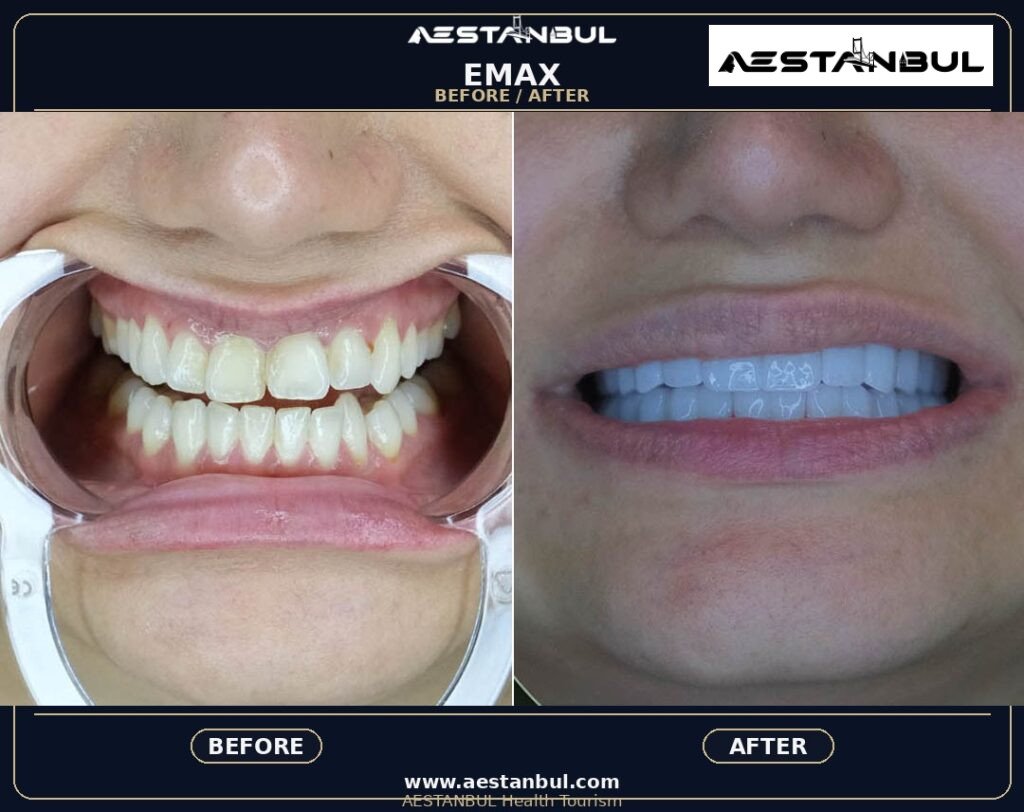 Dental Veneers Europe Package - Dental Veneers Europe Package: Package Review for European Patients for 2026