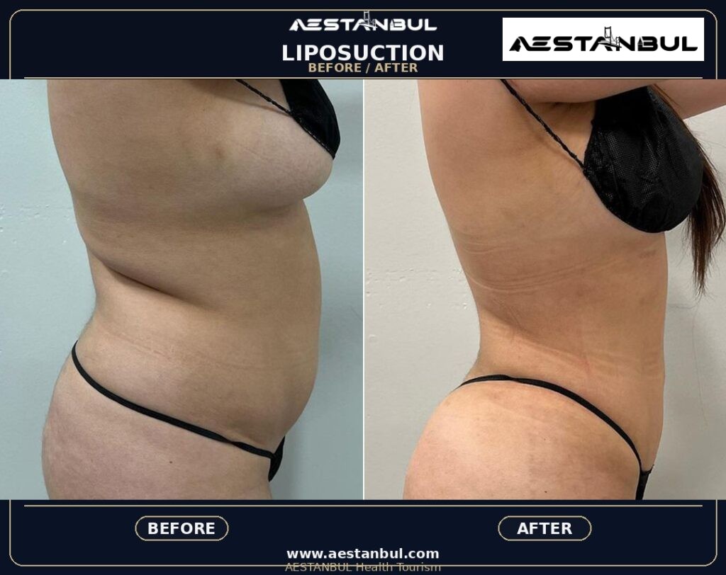 non surgical liposuction - Non Surgical Liposuction: What International Patients Should Know
