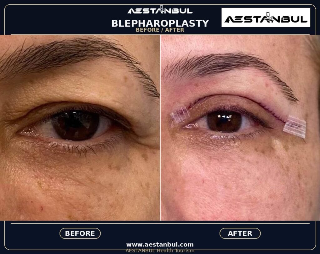 Blepharoplasty Price Safety - Blepharoplasty Price Safety: Price Versus Safety Comparison for 2026