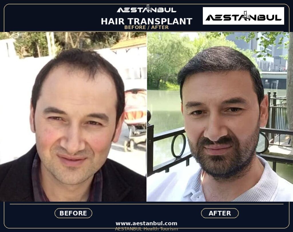 DHI Hair Transplant Clinic Red Flags - DHI Hair Transplant Clinic Red Flags: Clinic Red Flags and Safer Questions for 2026