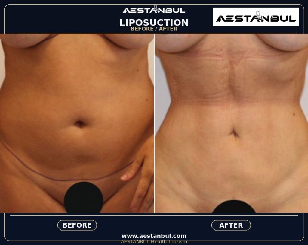 non surgical liposuction - Non Surgical Liposuction: What International Patients Should Know