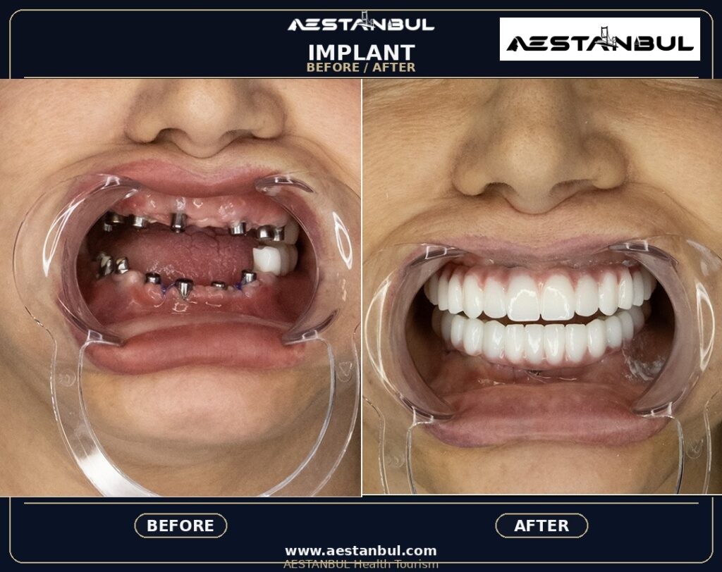 Dental Implants UK Checklist - Dental Implants Uk Checklist: UK Patient Checklist for 2026
