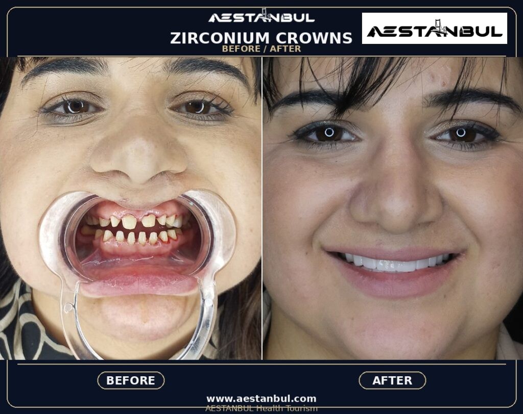 Corrective Jaw Surgery - Corrective Jaw Surgery: What International Patients Should Know