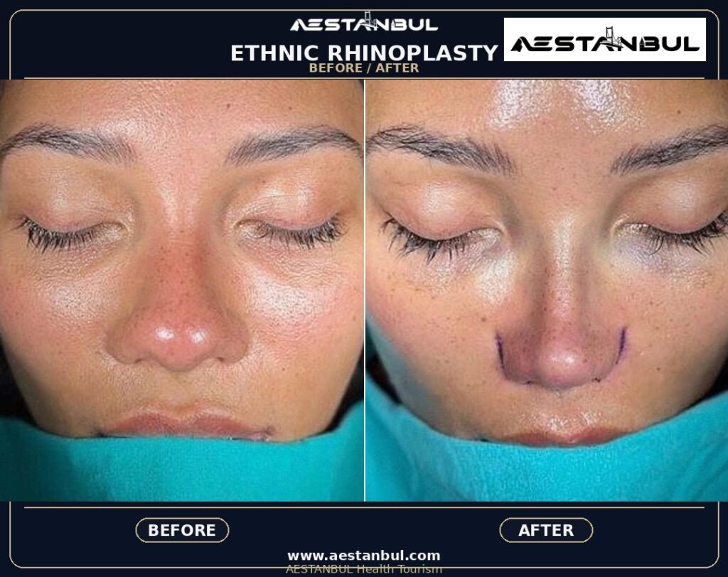 Rhinoplasty UK Checklist - Rhinoplasty Uk Checklist: UK Patient Checklist for 2026