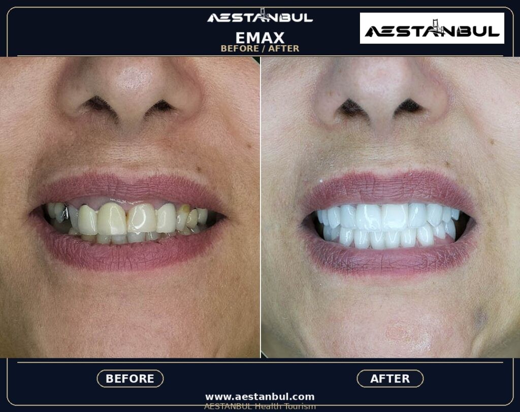 dental veneers before and after Turkey - Dental Veneers Before And After Turkey: Results, Safety and Patient Questions