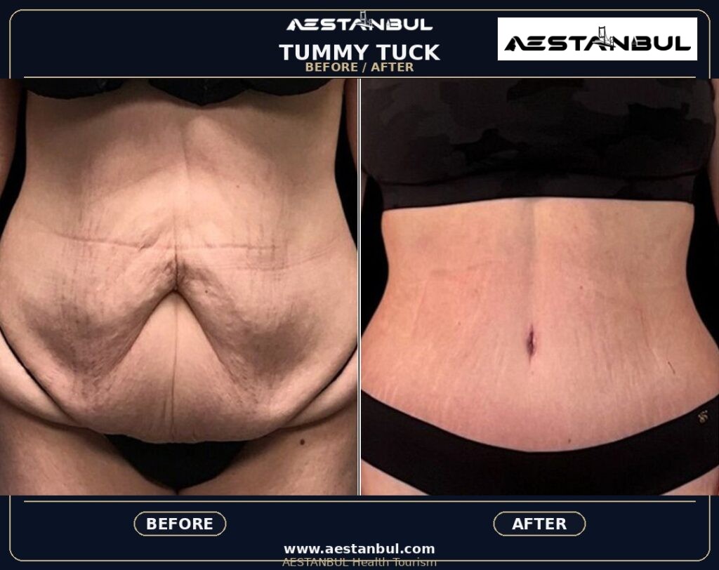 Tummy Tuck Deposit Questions - Tummy Tuck Deposit Questions: Deposit Questions Before Booking for 2026