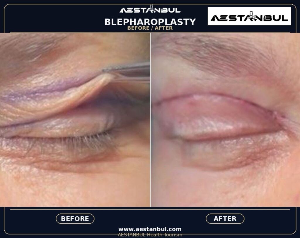 Blepharoplasty Europe Package - Blepharoplasty Europe Package: Package Review for European Patients for 2026