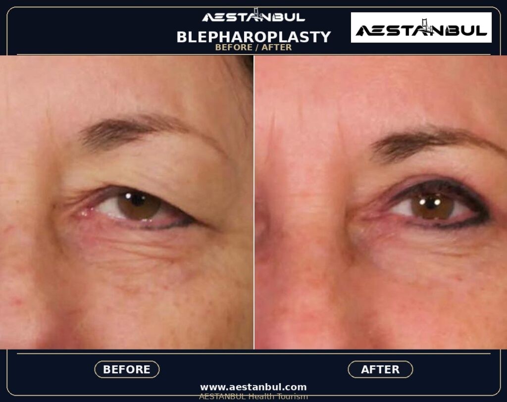 Blepharoplasty Europe Package - Blepharoplasty Europe Package: Package Review for European Patients for 2026