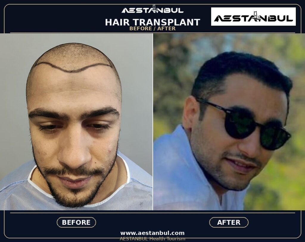 laser hair removal Istanbul - Laser Hair Removal Istanbul: What International Patients Should Know
