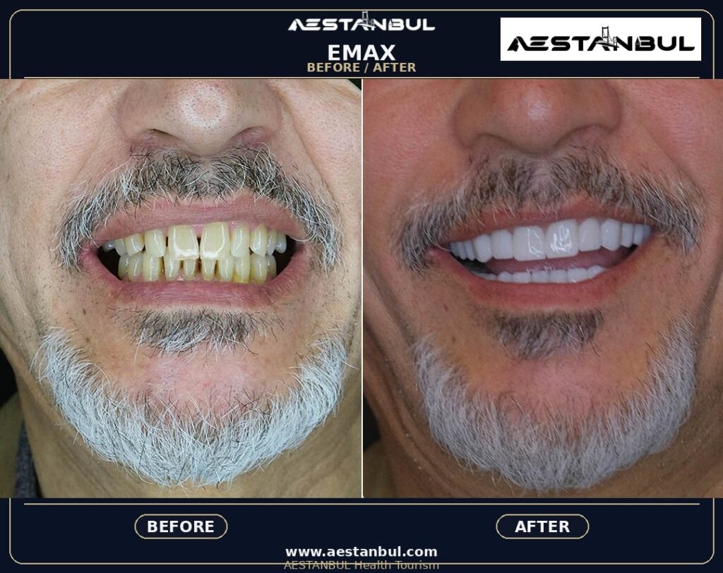 Dental Veneers Europe Package - Dental Veneers Europe Package: Package Review for European Patients for 2026