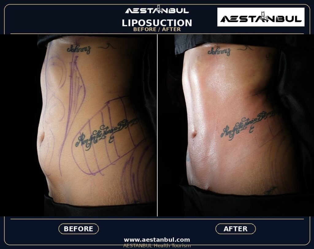 liposuction before and after Turkey - Liposuction Before And After Turkey: Results, Safety and Patient Questions