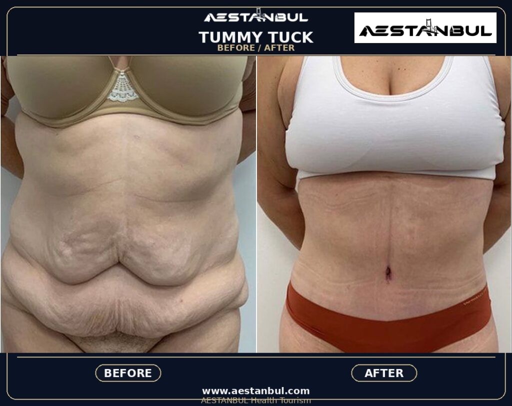 Tummy Tuck Deposit Questions - Tummy Tuck Deposit Questions: Deposit Questions Before Booking for 2026