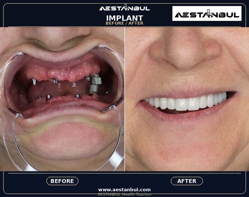 Dental Implants Photo Consultation - Dental Implants Photo Consultation: Photo Consultation Checklist for 2026